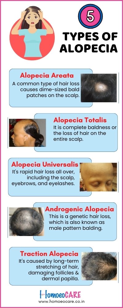 5 types of alopecia